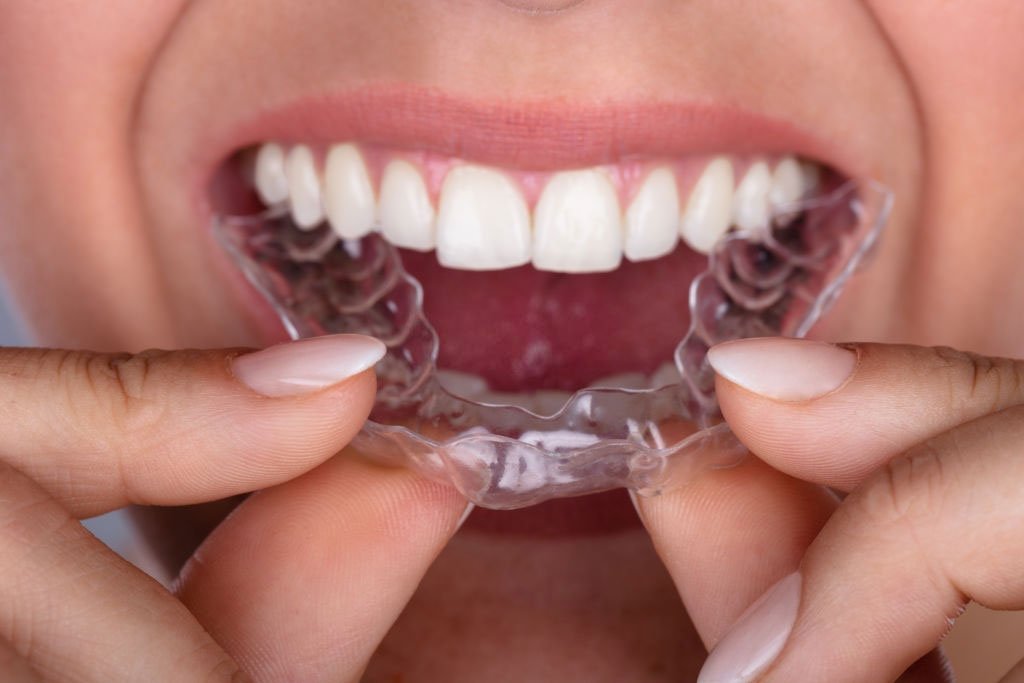 Aparelho invisível - Alinhador - Dentista em Santo André - Rubi Odonto